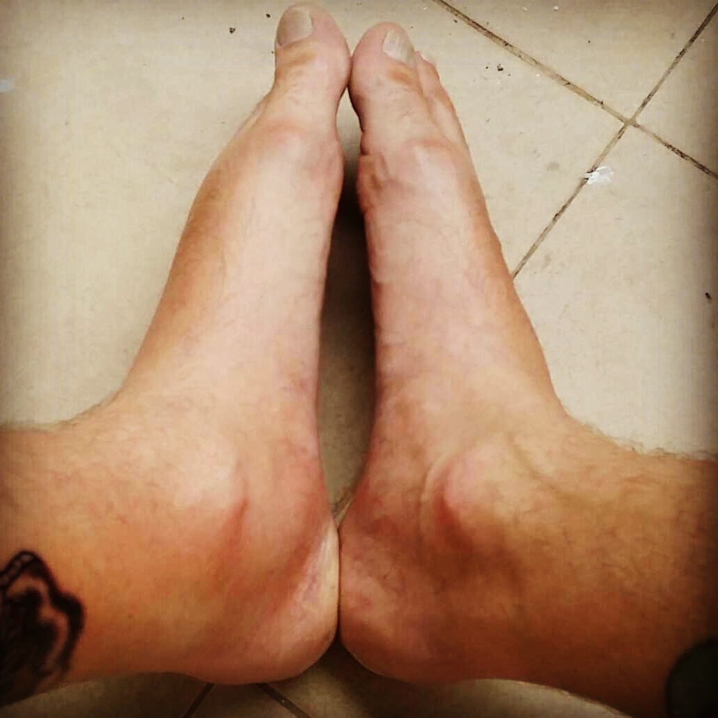 Feet And Ankle Swelling After Leg Tattoo Midlifemate in size 1029 X 1029