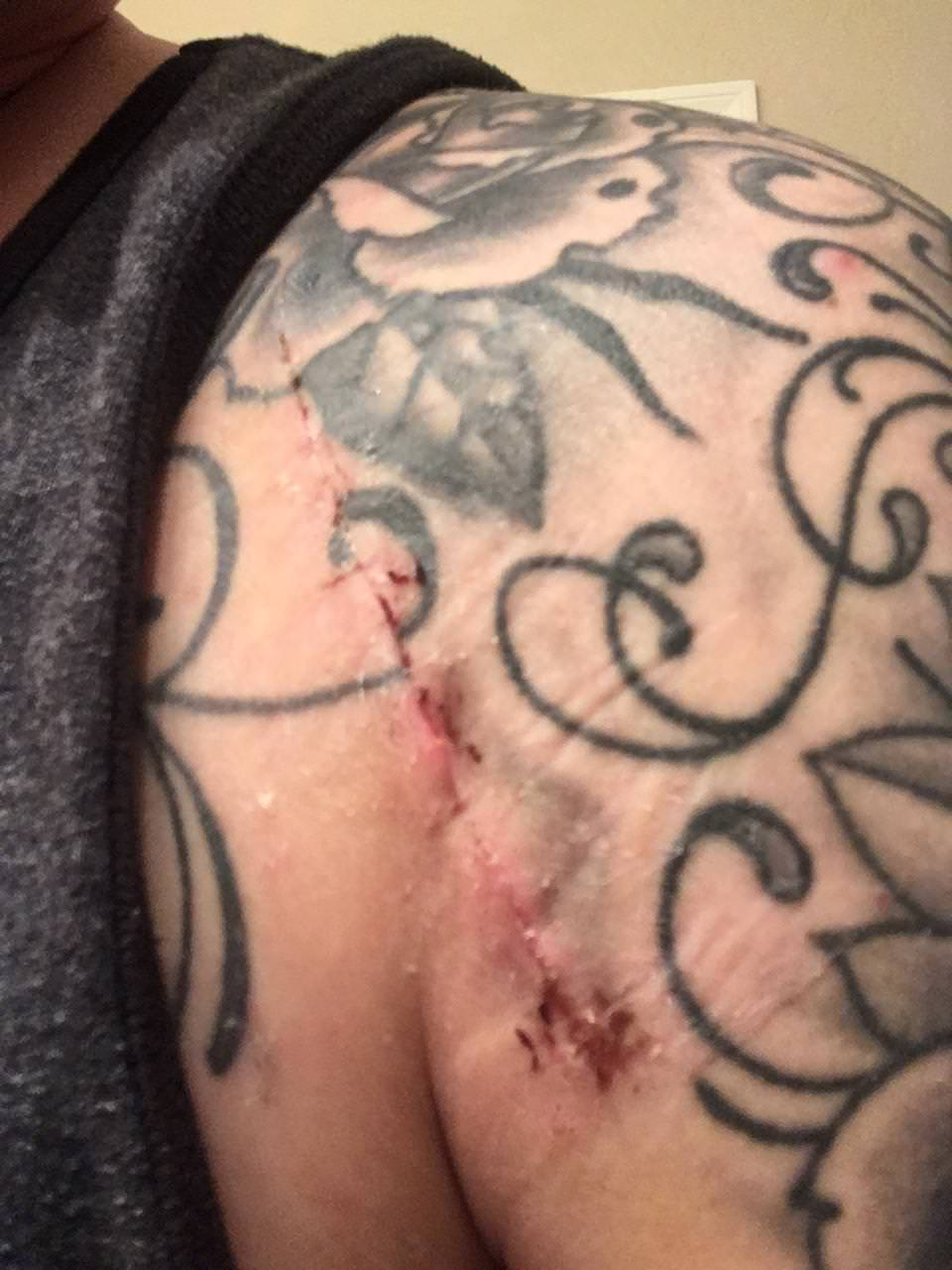 My Tattoo Is Just Slightly Off After My Shoulder Surgery within sizing 960 X 1280
